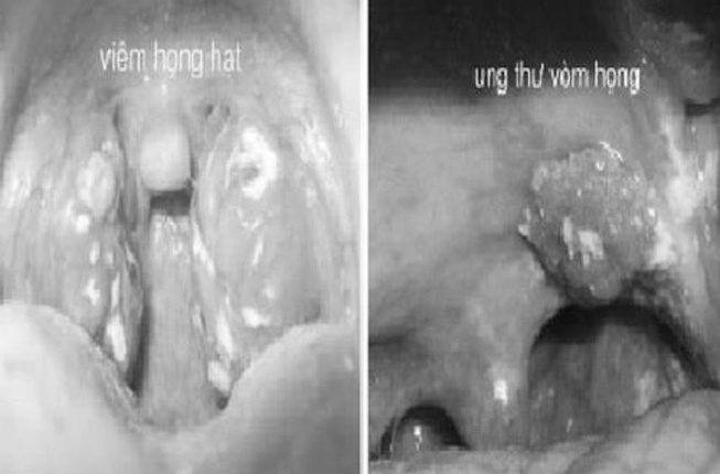 ung-thu-vom-hong_txko_thumb